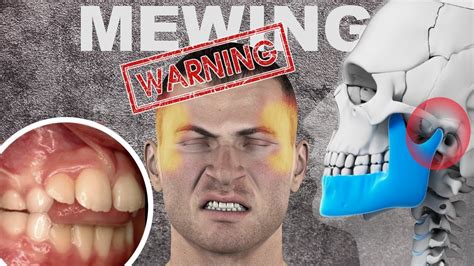 mewing danger|The Dangers of Mewing/Jawline Exercises .